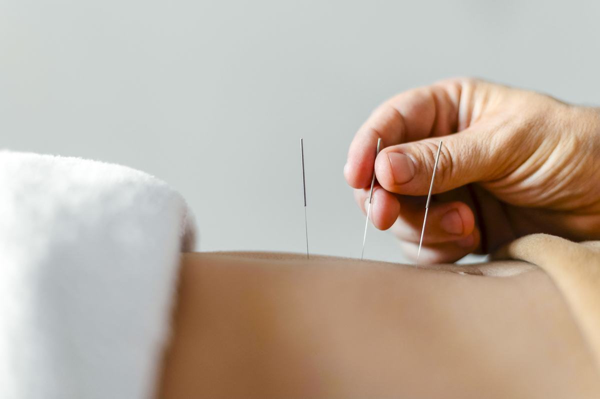 An acupuncture needle being placed during treatment.